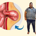 Understanding Obesity and Hernias