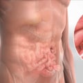 Hernia Types and Causes: A Comprehensive Overview